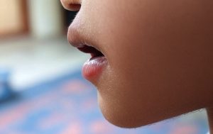 Mouth Ulcer